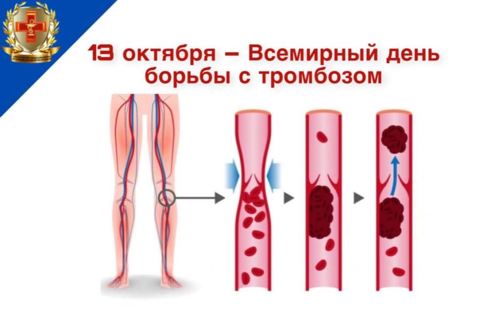 13 ������� �������������� ���� ������ � ��������� (World Thrombosis Day)