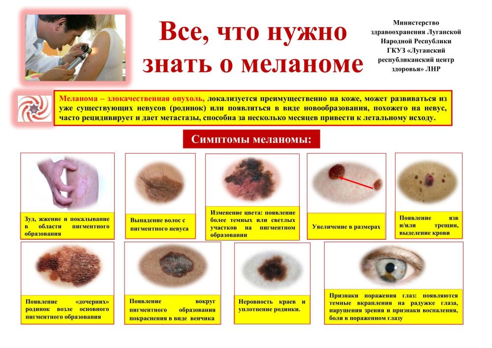 Памятка меланома. С возрастом кожа претерпевает множество изменений, которые могут сказаться на её внешнем виде и состоянии