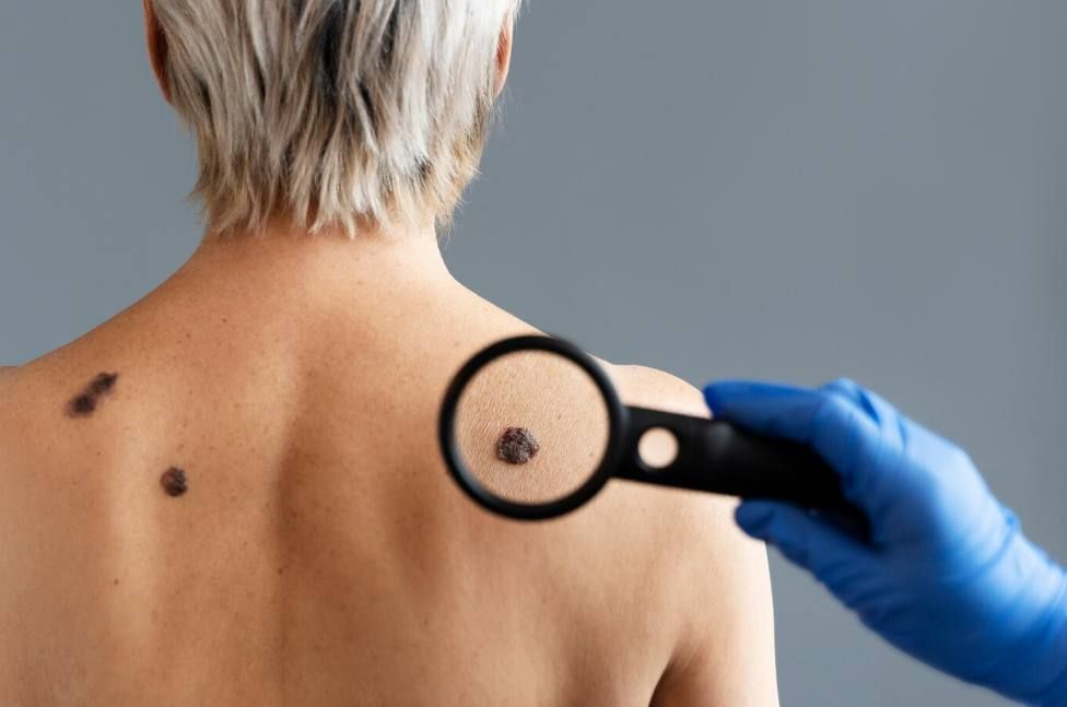 Брянковская центральная городская многопрофильная больница ЛНР информирует жителей г. Брянка о проведении недели по выявлению злокачественных новообразований кожи