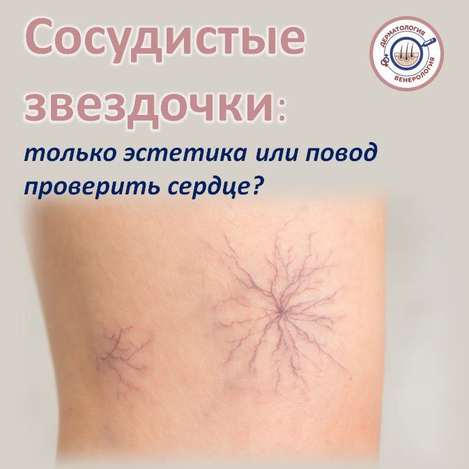 Вы замечали у себя тонкие красные или синие линии, похожие на паутинки, звездочки или веточки? Чаще всего они появляются на ногах, но могут «расцветать» и на лице, и на груди, и на животе