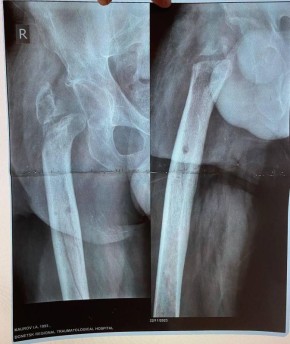 Уникальная операция в Луганской республиканской клинической больнице вернула ветерану специальной военной операции возможность ходить без хромоты