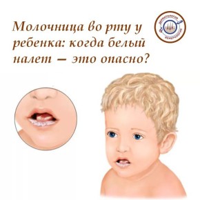 Белый налет во рту у ребенка: безобидные "молочные" следы или опасная инфекция?