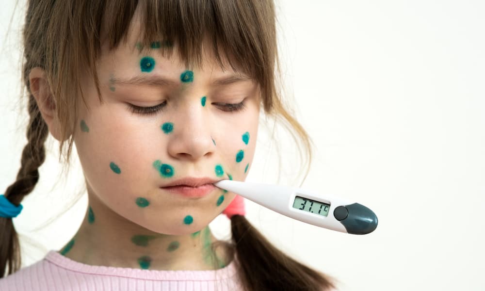 Ветряная оспа: что нужно знать!