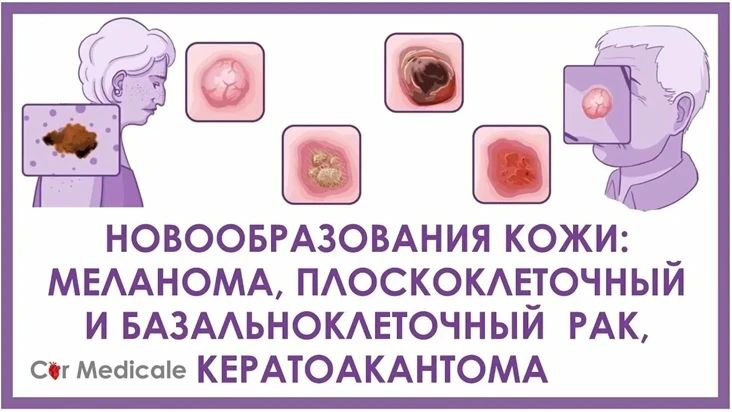 Злокачественные новообразования кожи