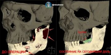 Гигантская киста почти "растворила" челюсть мужчины – костные стенки истончились настолько, что стало сложно открывать рот
